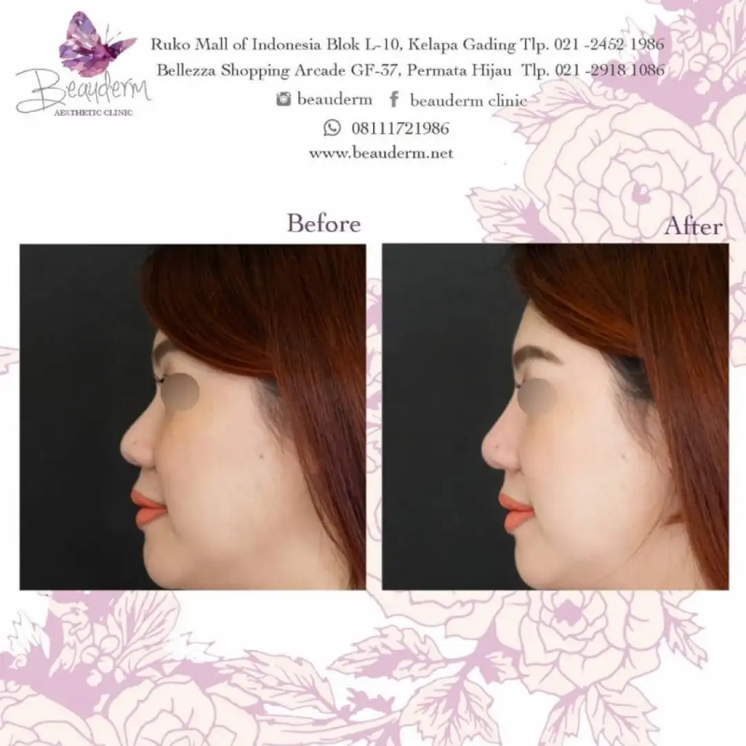 Filler Hidung / Nose Filler